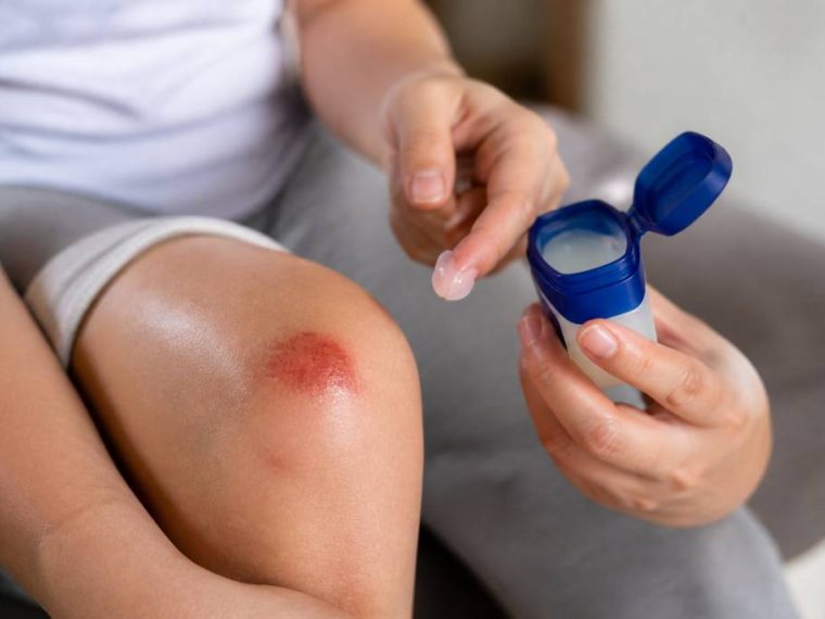 Vaseline sur plaie : est-ce une bonne idée pour favoriser la cicatrisation ?