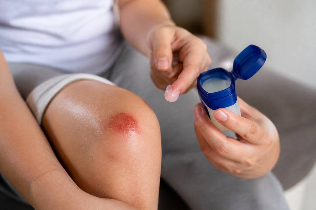 Vaseline sur plaie : est-ce une bonne idée pour favoriser la cicatrisation ?